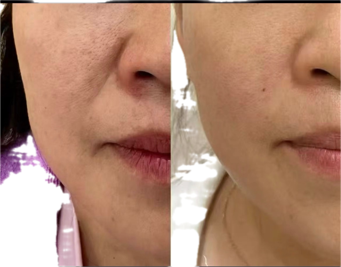 Before and after skincare comparison showing reduced acne and improved facial complexion