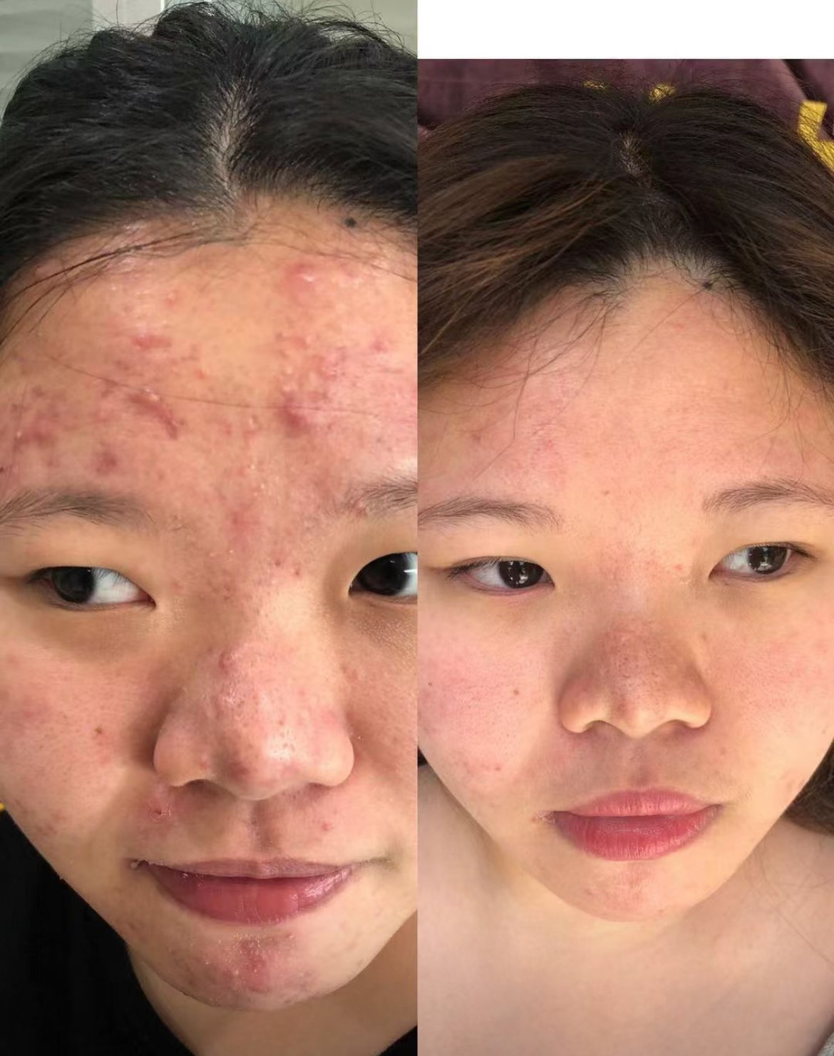 Before and after comparison showing acne-prone forehead and clearer skin treatment results