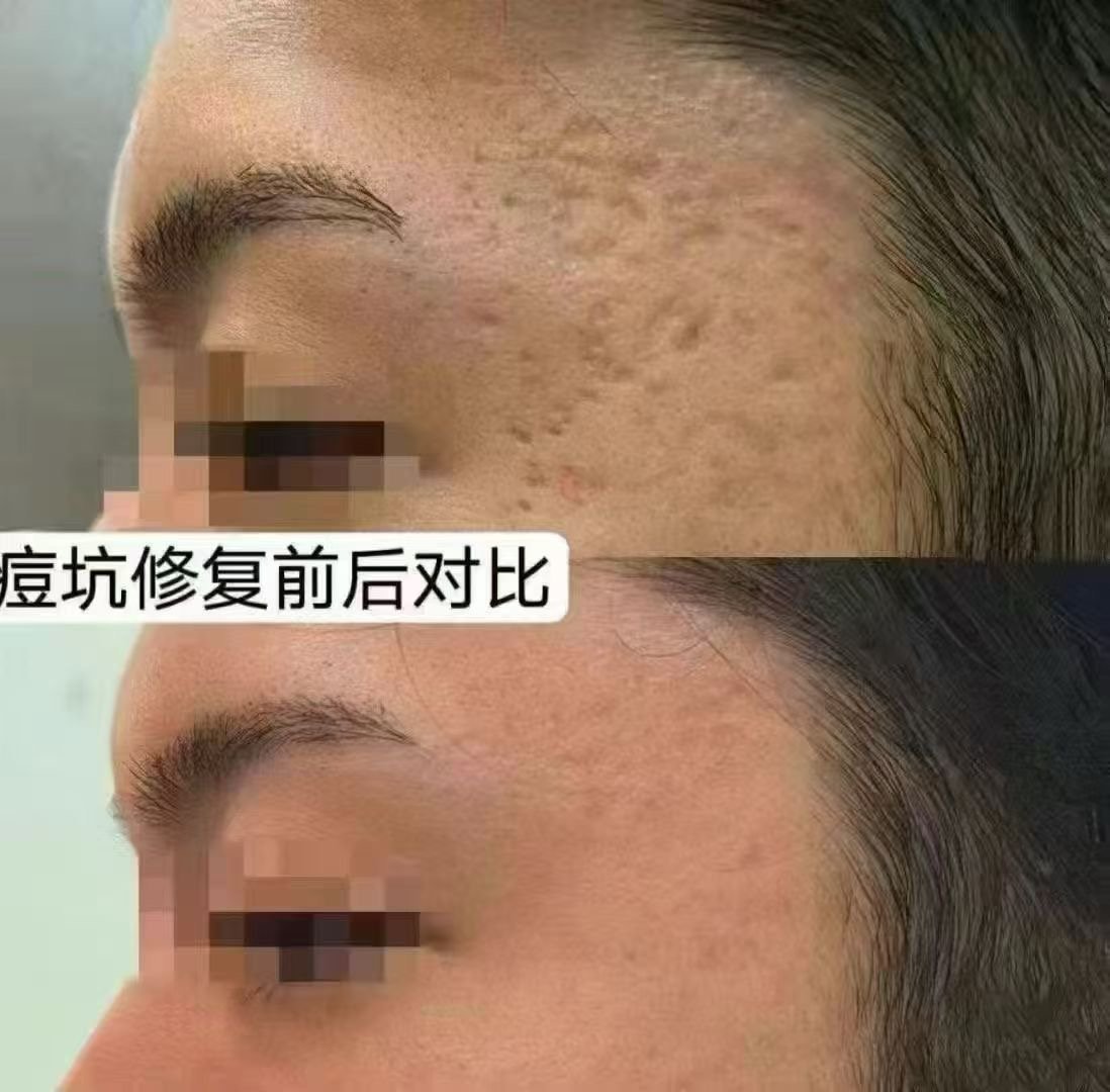 Before and after comparison of acne scar treatment on person's cheek