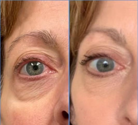 Before and after comparison of eye treatment showing reduced redness and improved appearance